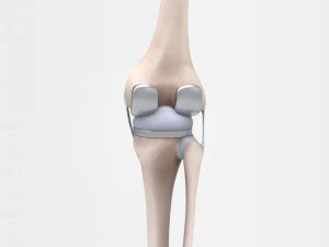 膝关节置换术 3D 模型