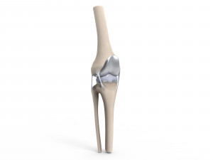 Knee Replacement Modello 3D