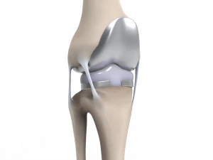 膝关节置换术 3D 模型