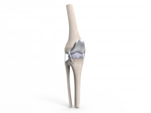 Knee Replacement Modello 3D