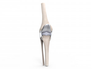 Knee Replacement Modello 3D