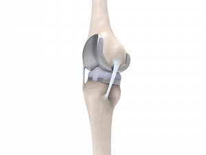 Knee Replacement Modello 3D