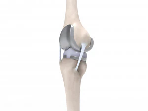 膝关节置换术 3D 模型