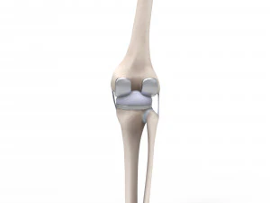 膝关节置换术 3D 模型