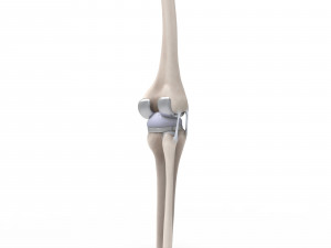 Knee Replacement Modello 3D