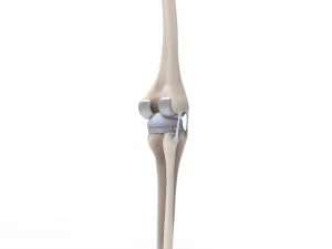 膝关节置换术 3D 模型