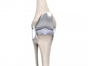 Knee Replacement Modello 3D