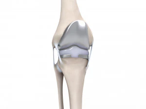 膝关节置换术 3D 模型