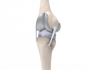 Knee Replacement Modello 3D