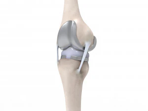 膝关节置换术 3D 模型