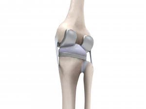 膝关节置换术 3D 模型