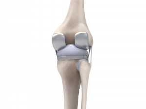 Knee Replacement Modello 3D