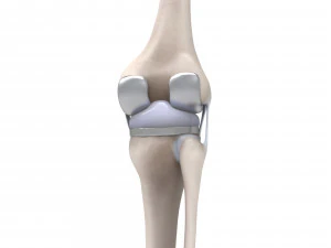 膝关节置换术 3D 模型