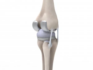膝关节置换术 3D 模型