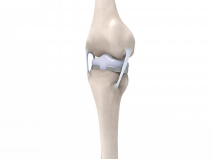 Knee Replacement Modello 3D