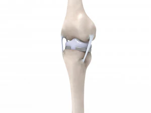 膝关节置换术 3D 模型