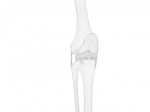 膝关节置换术 3D 模型