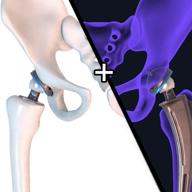 Hip replacement implant installed in the pelvis bone 3D Model .c4d .max .obj .3ds .fbx .lwo .lw .lws