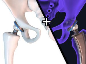 Hip replacement implant installed in the pelvis bone 3D Model