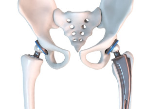 Hip replacement implant installed in the pelvis bone 3D Модель