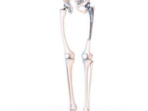 Hip replacement implant installed in the pelvis bone 3D Модель