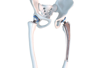 Hip replacement implant installed in the pelvis bone 3D Модель