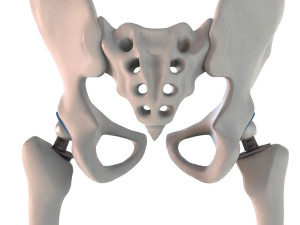 Hip replacement implant installed in the pelvis bone 3D Модель