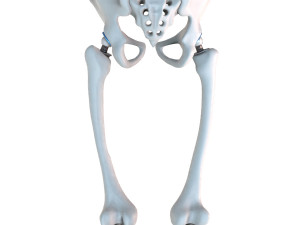Hip replacement implant installed in the pelvis bone 3D Модель