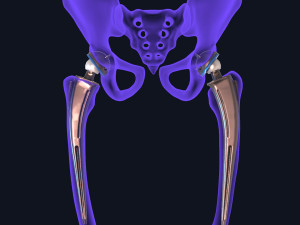 Hip replacement implant installed in the pelvis bone 3D Модель