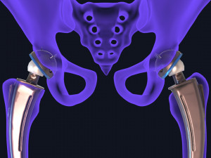 Hip replacement implant installed in the pelvis bone 3D Модель