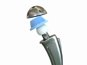 Hip replacement implant and 4 bonus texture 3D Model