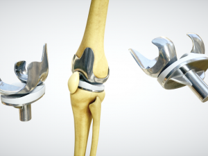 knee endoprosthesis 3D Model