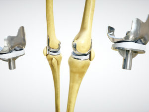 knee endoprosthesis 3D 모델