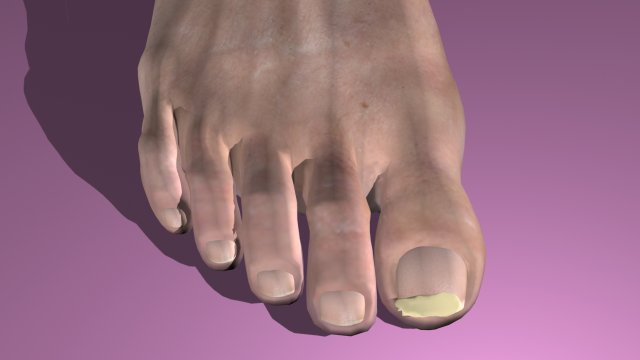 onchomycosis nail fungus Modelo 3D .c4d .max .obj .3ds .fbx .stl .blend 