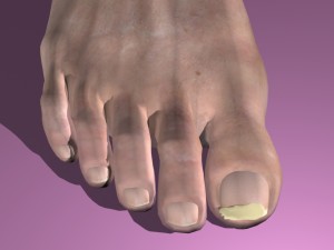 onchomycosis nail fungus 3D Model