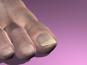 onchomycosis nail fungus Modelo 3D