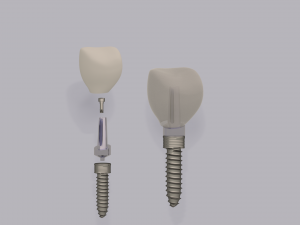 dental implant 3D Model