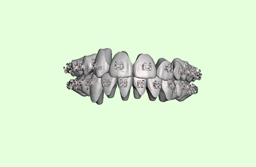 orthodontic aligners 3D Model .c4d .max .obj .3ds .fbx .stl .blend 
