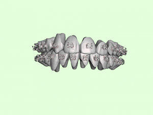 orthodontic aligners 3D Model