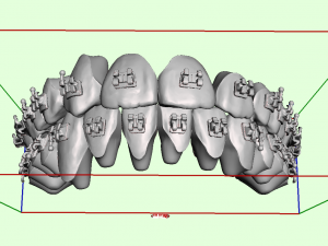 orthodontic aligners 3D Model