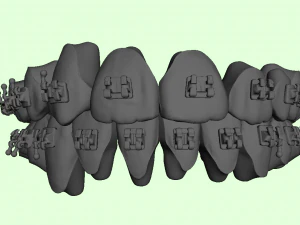 orthodontic aligners 3D Model