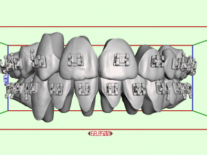 orthodontic aligners 3D Model