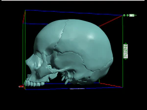 खोपड़ी खंडित 3D प्रिंट मॉडल
