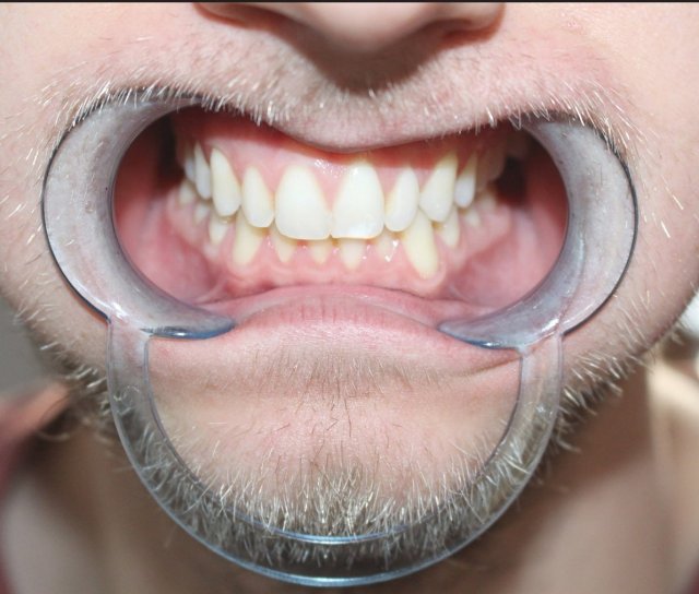 dental retractor 3D Model .c4d .max .obj .3ds .fbx .stl .blend 