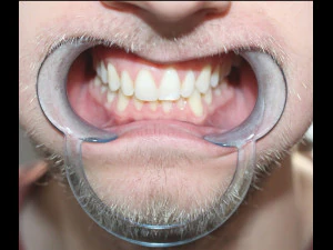 afastador dent&aacute;rio Modelo 3D