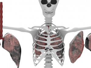 smoker lungs Modèle 3D