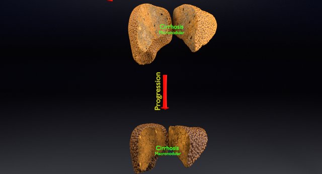 3D Alchoholic liver disease cirrhosis hepatitis fatty model Modelo 3D .c4d .max .obj .3ds .fbx .stl .blend 