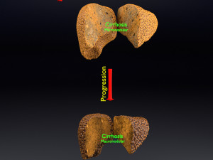 3D Alchoholic liver disease cirrhosis hepatitis fatty model 3D Model