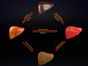 3D Alchoholic liver disease cirrhosis hepatitis fatty model Modelo 3D