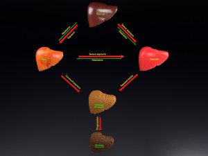 3D Alchoholic liver disease cirrhosis hepatitis fatty model Modelo 3D